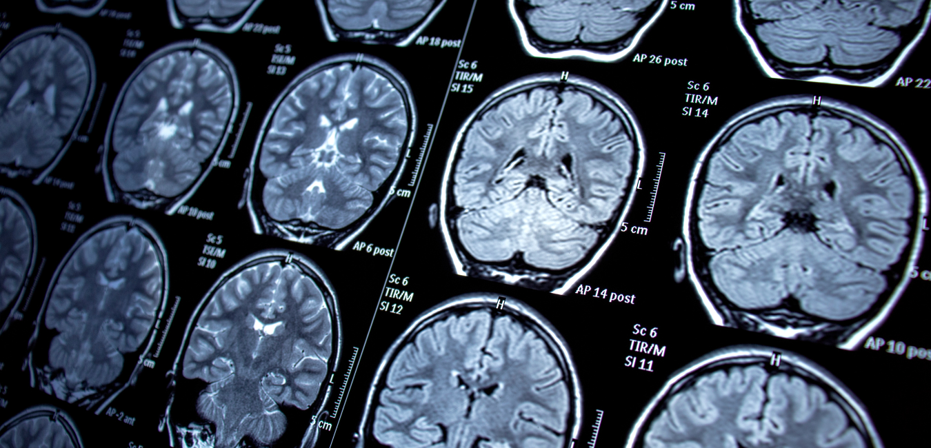 Neuro nclex questions